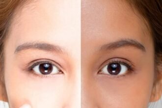 Vitamin Deficiency Dark Skin