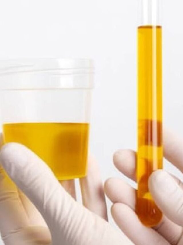 Foods To Avoid in Uric Acid