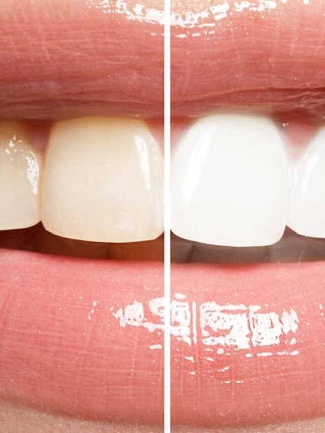 Home Remedies For Yellow Teeth Problem